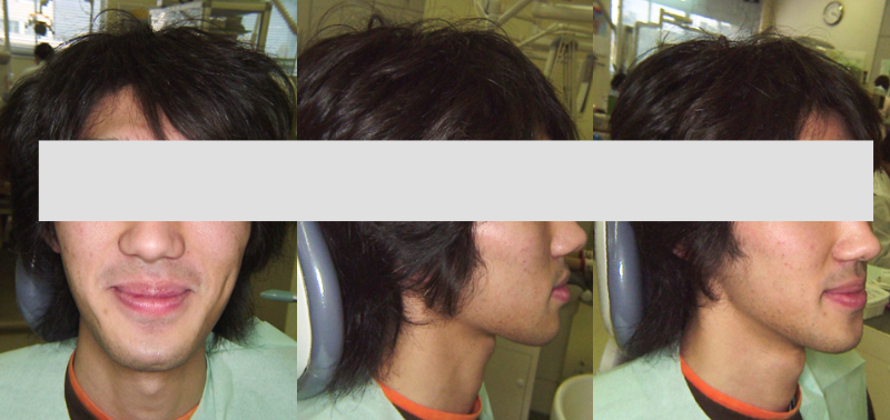 受け口矯正治療後の顔写真