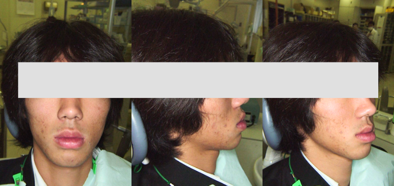 受け口矯正治療前の顔写真